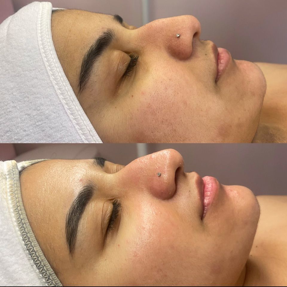 Glow Facial Result at Aurra Luxury Salon